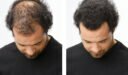 علاج تساقط الشعر للرجال