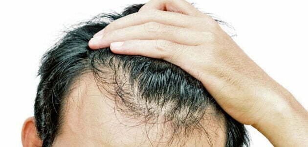 ما هو الفيتامين الذي يمنع تساقط الشعر