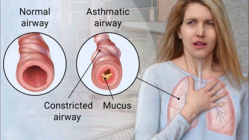 التفريق بين الربو (Asthma) والحساسية الصدرية
