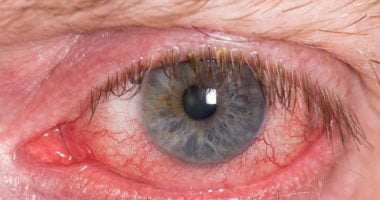 أضرار نقص فيتامين أ على العين 