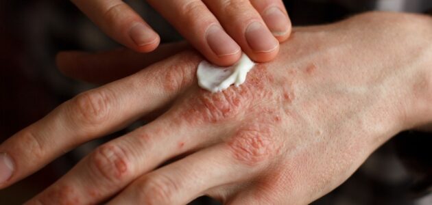 تقشر الجلد في المنطقة الحسّاسة أسباب وعلاجات هذه الحالة