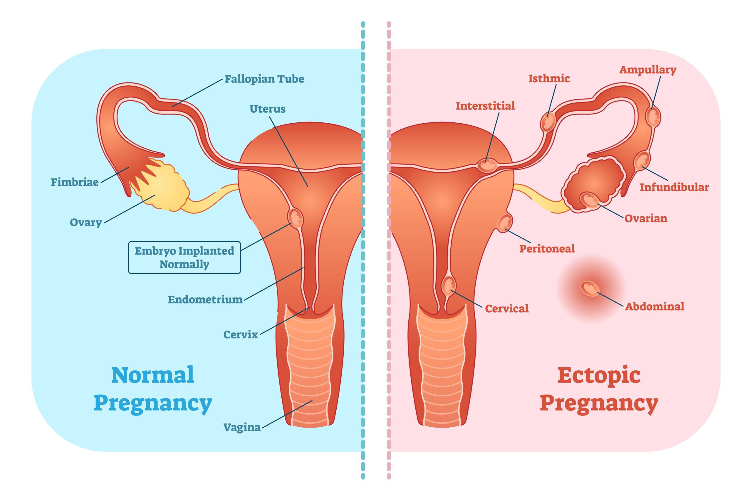 تعريف الحمل خارج الرحم Ectopic Pregnancy