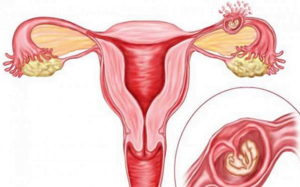 نتائج الحمل خارج الرحم
