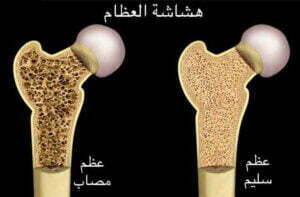 علاج إصابة هشاشة العظام