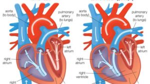 قصور القلب البطين الأيسر الحاد