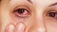 أسباب التهاب العين وطرق العلاج