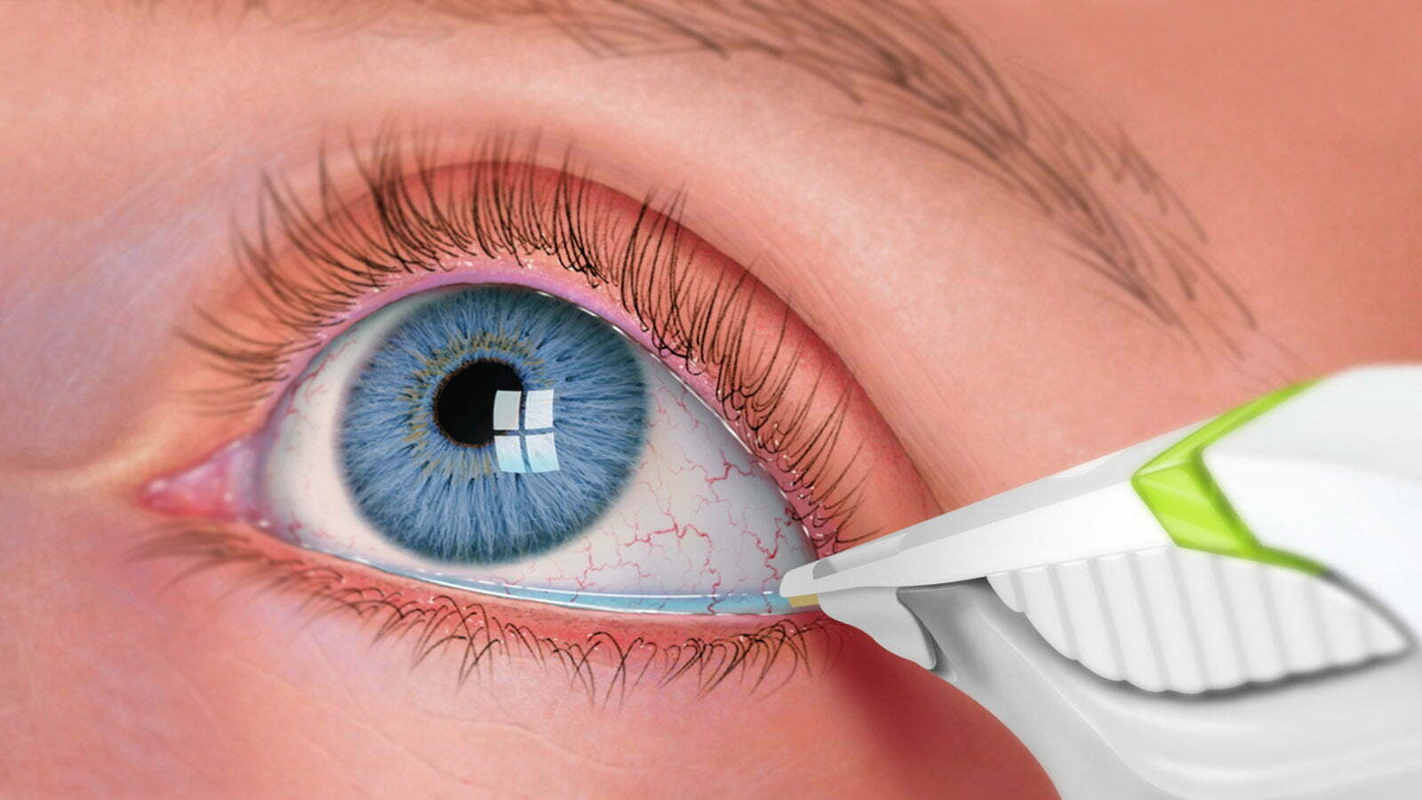 أعراض متلازمة العين الجافة