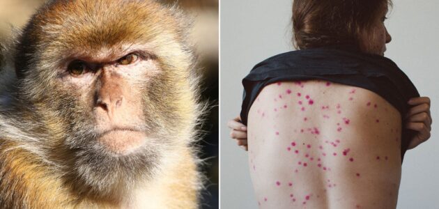 ما هي أعراض مرض جدري القرود وإجراءات الوقاية