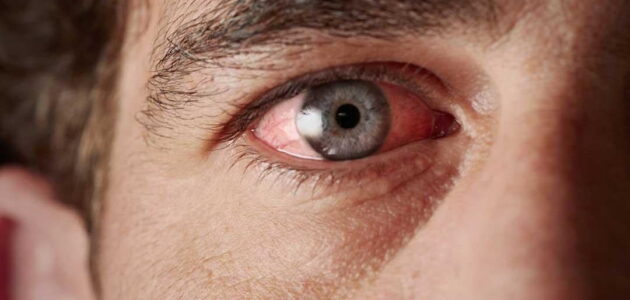 أسباب رمد العين وأعراضه وطرق العلاج