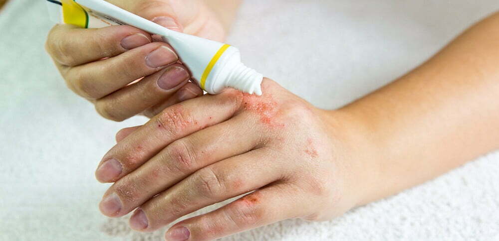 أسباب وعلاج حساسية الجلد من الإكزيما