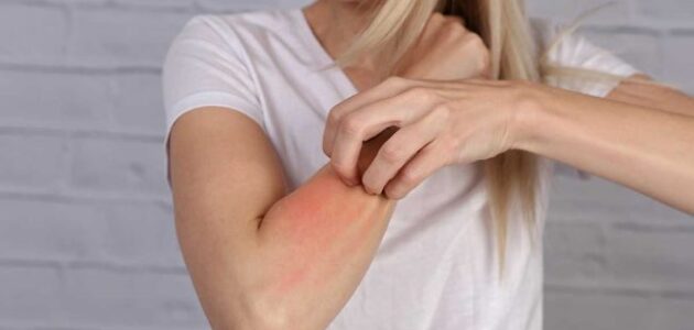أسباب وعلاج حساسية الجلد وما هي أنواعها