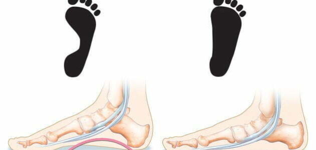 القدم المسطحة الأسباب والأعراض والعلاج