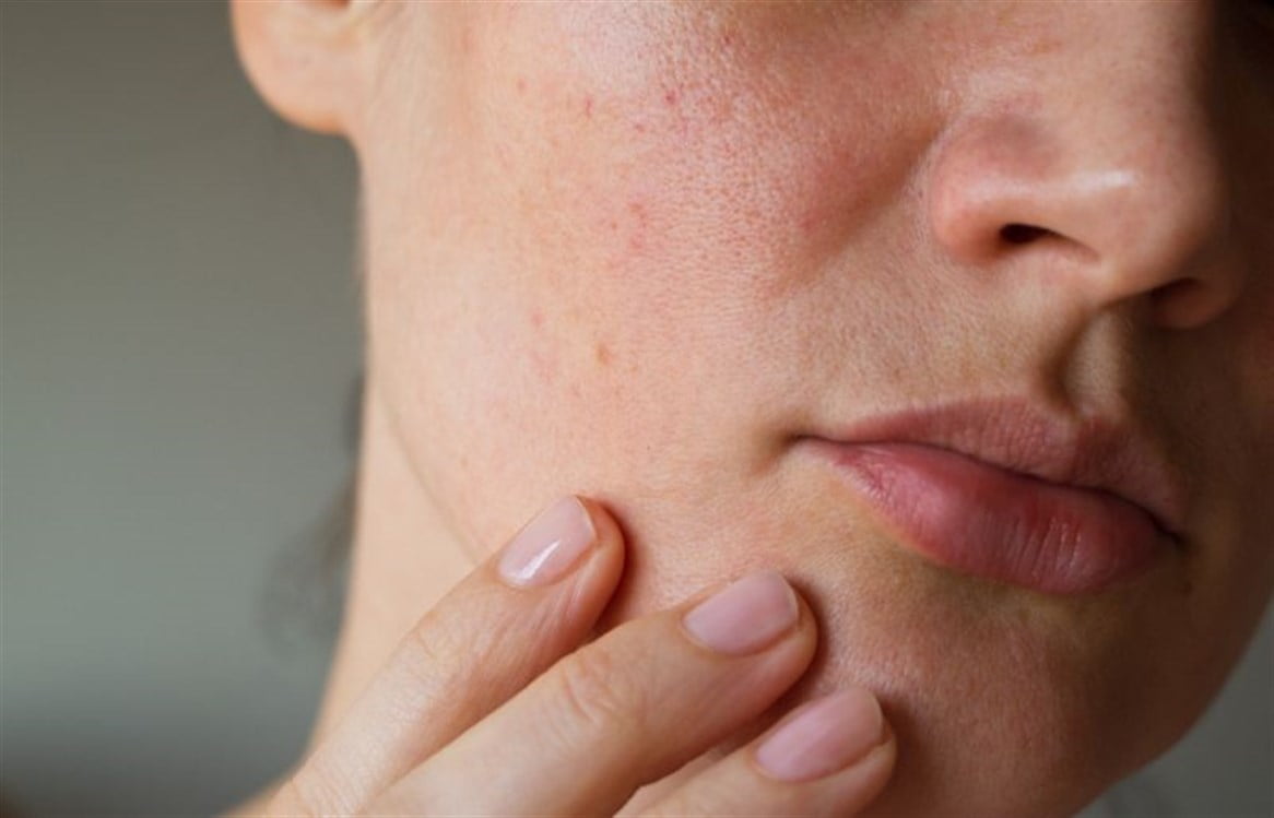 طرق علاج زيادة إفراز الدهون في الوجه